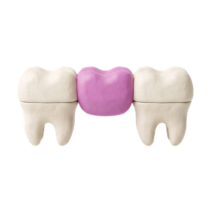 Dental Bridges