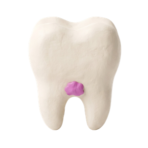 Gingivitis